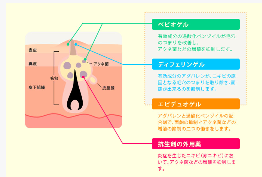 にきびの詳細画像