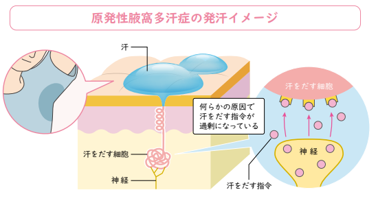 原発性腋窩多汗症の発汗イメージ